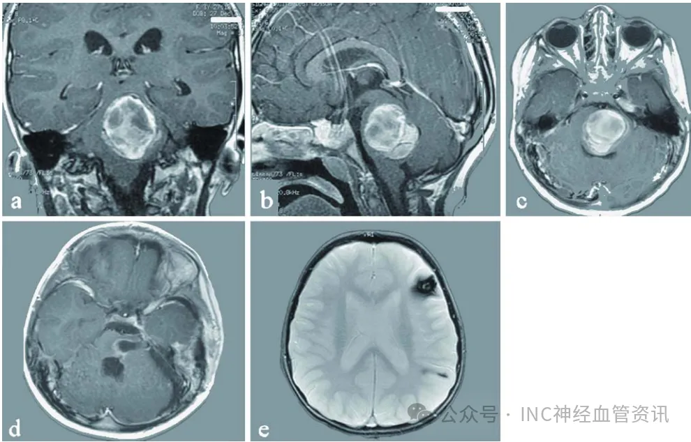 腦血管瘤案例圖片